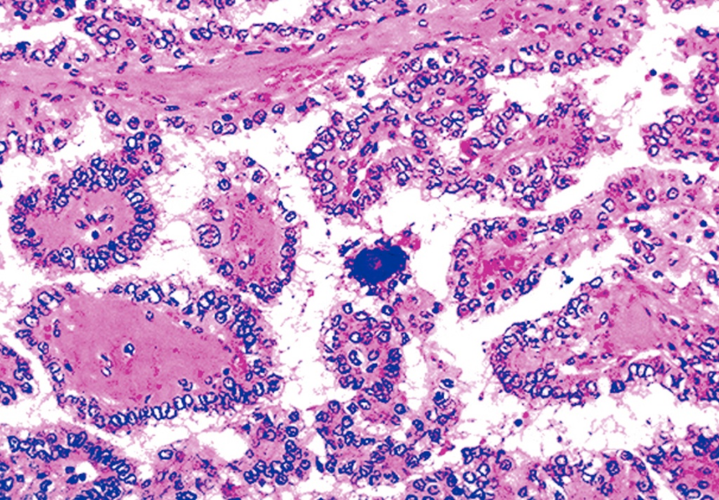 Adenocarcinoma Adenocarcinoma With Papillary Features